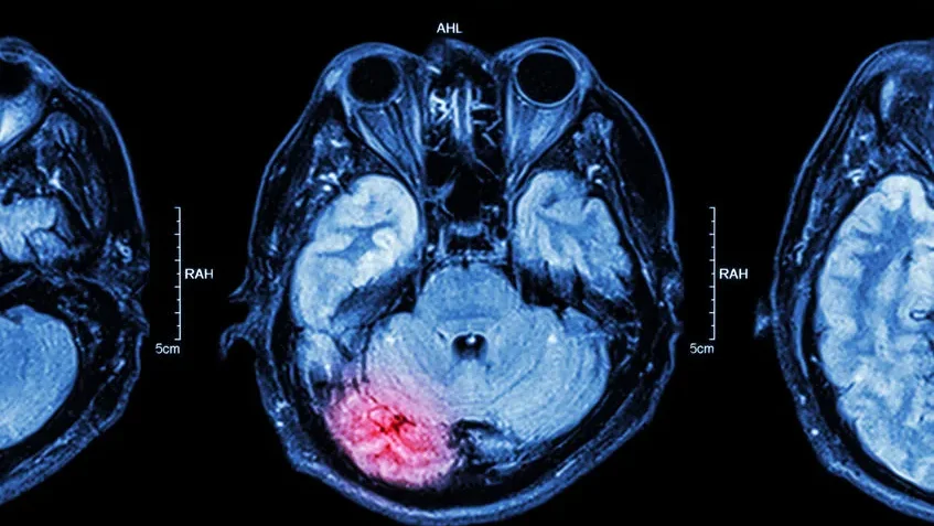 Doenças Neurologicas